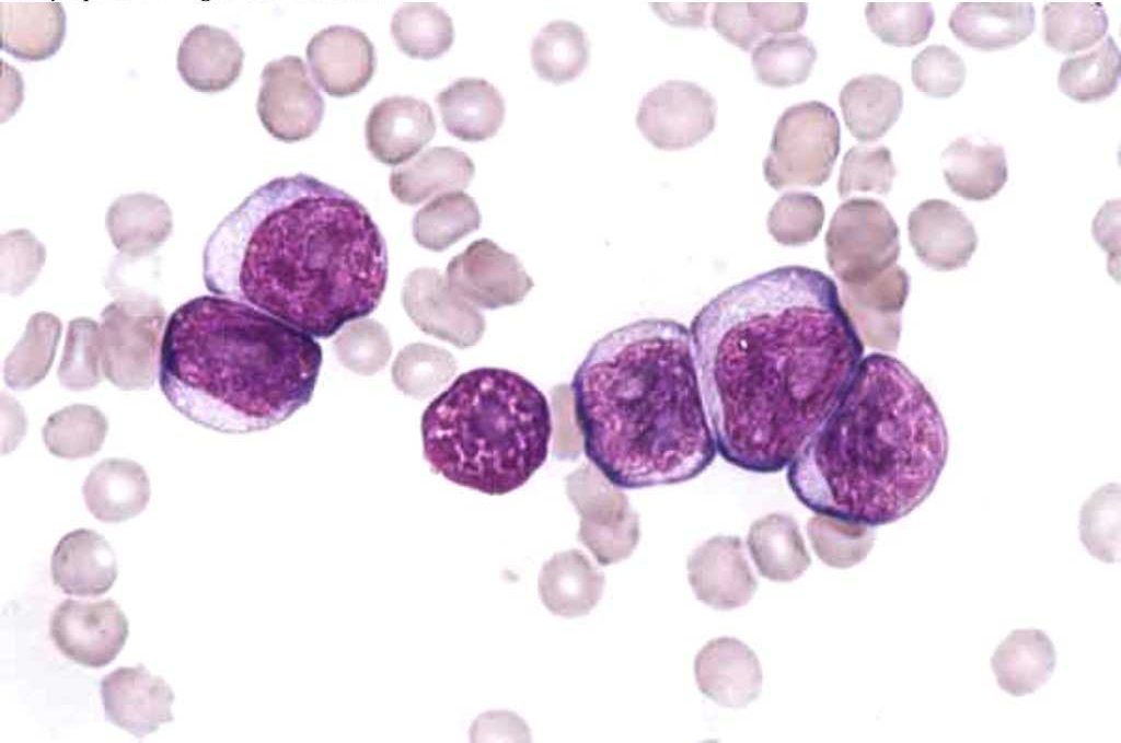 Figure 3.3 Blood film from a dog with acute lymphocytic/lymphoblastic leukemia (ALL). Nucleoli are particularly prominent in most of the cells. The cell in the middle is not intact as it has been stripped of its cytoplasm. Wright-Giemsa stain.