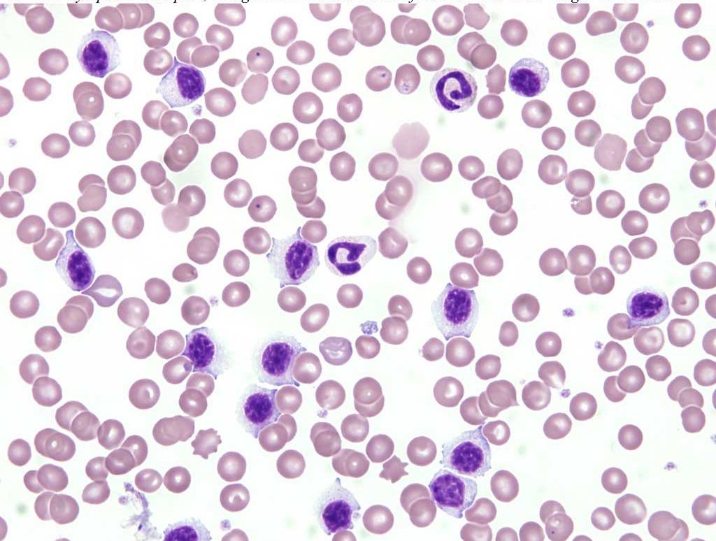 Figure 3.4 Blood film from a dog with chronic lymphocytic leukemia (CLL). There is an abundance of lymphocytes in the field. Nuclei are similar in size to the erythrocytes and nuclear morphology is normal. Cytoplasms are pale, though more abundant than often seen with CLL. Wright-Giemsa stain.