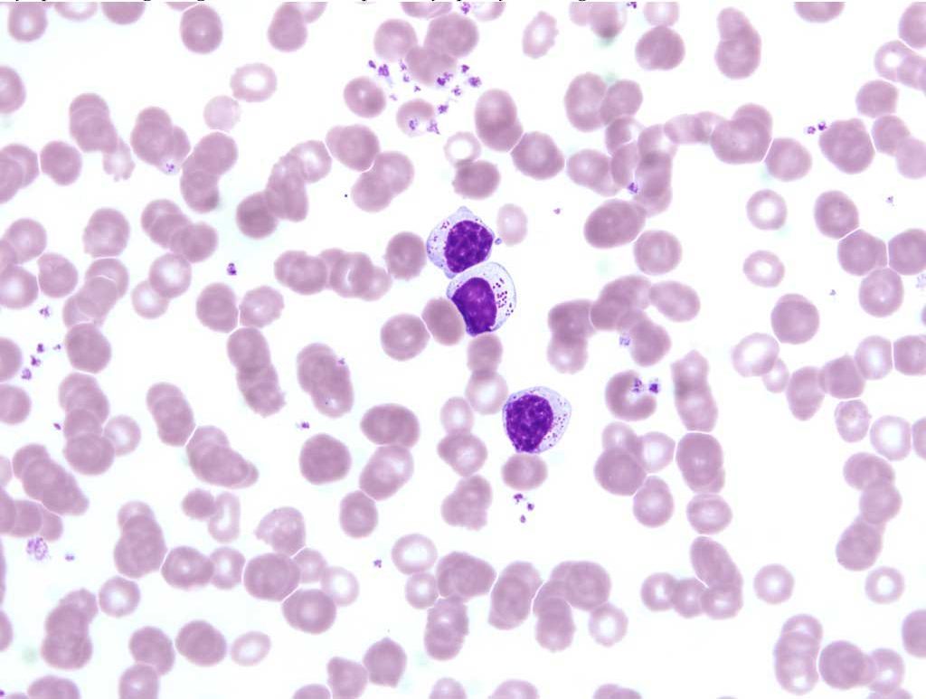 Figure 3.5 Blood film from a dog with large granular lymphocytic (LGL) leukemia. Note the prominent cytoplasmic magenta granules in the neoplastic lymphocytes. Wright-Giemsa stain.