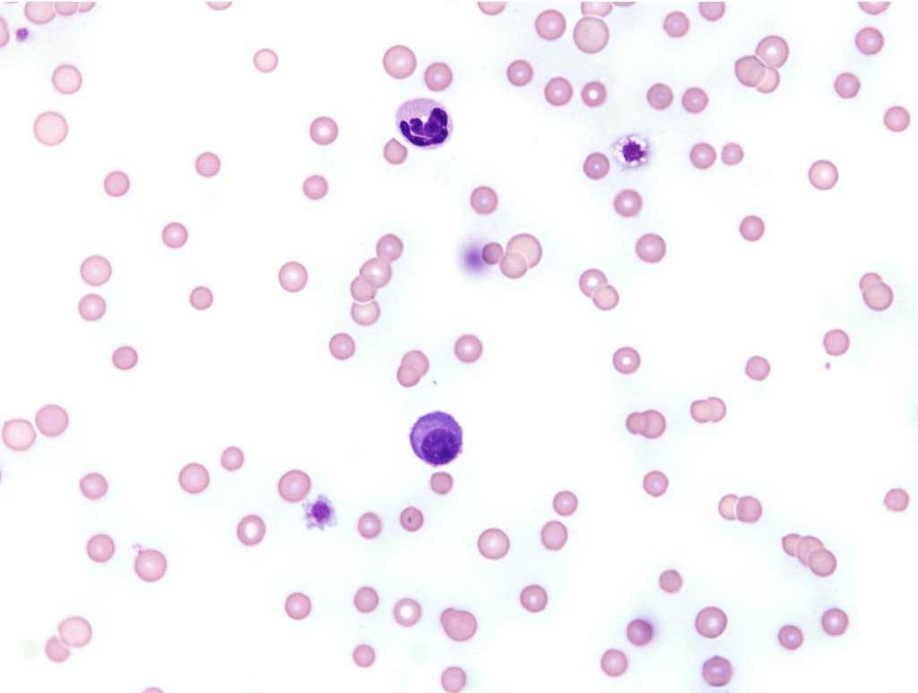 Figure 3.6 Blood film from a cat with plasma cell leukemia. One plasma cell is present in the field.Note the rouleaux formation despite the paucity of erythrocytes in the field suggesting the presence of hyperproteinemia, in this case due to a monoclonal gammopathy. Wright-Giemsa stain