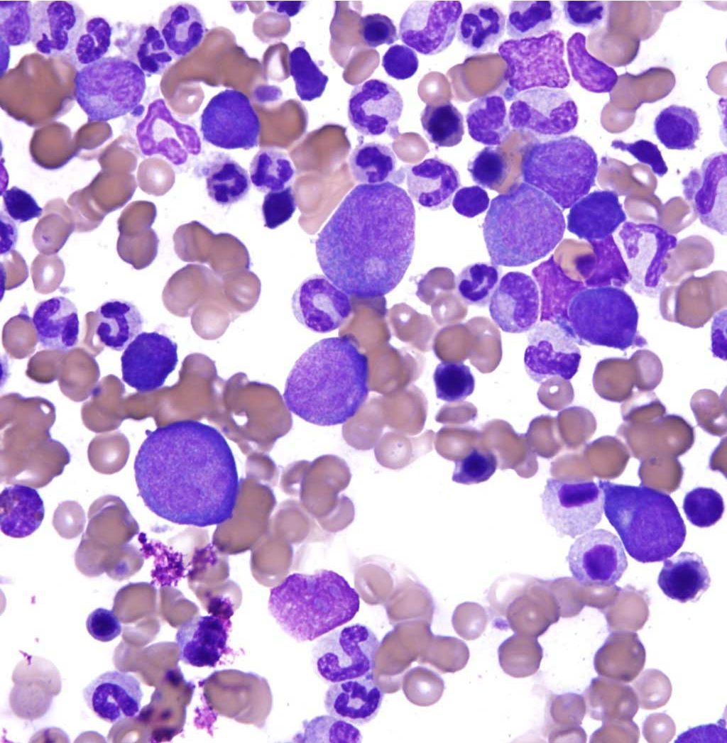 Figure 3.8 Bone marrow film from a dog. Three myeloblasts are shown near the centre of the field.Blast cells are enumerated when categorizing myeloid tumors as acute or chronic. Wright-Giemsa stain.