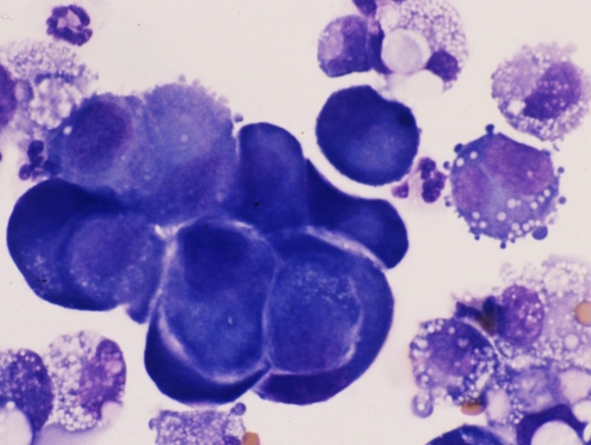 Figure 5.17 Nuclear molding in a carcinoma. The carcinoma cells are very large with darkly staining cytoplasms. (Wright-Giemsa; HP oil.)