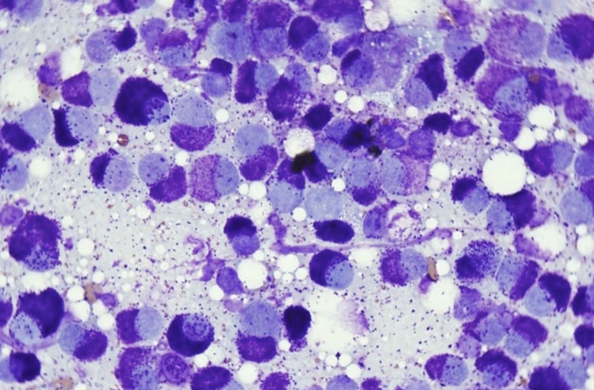 Figure 5.18 Well differentiated mast cells from a fine needle sample of a mast cell tumor. There are purple granules in the background as well as within mast cells. Pale-staining nuclei are often seen in mast cell samples. (Wright-Giemsa; HP oil.) (Image courtesy of Dr. Angelica Galezowski.)