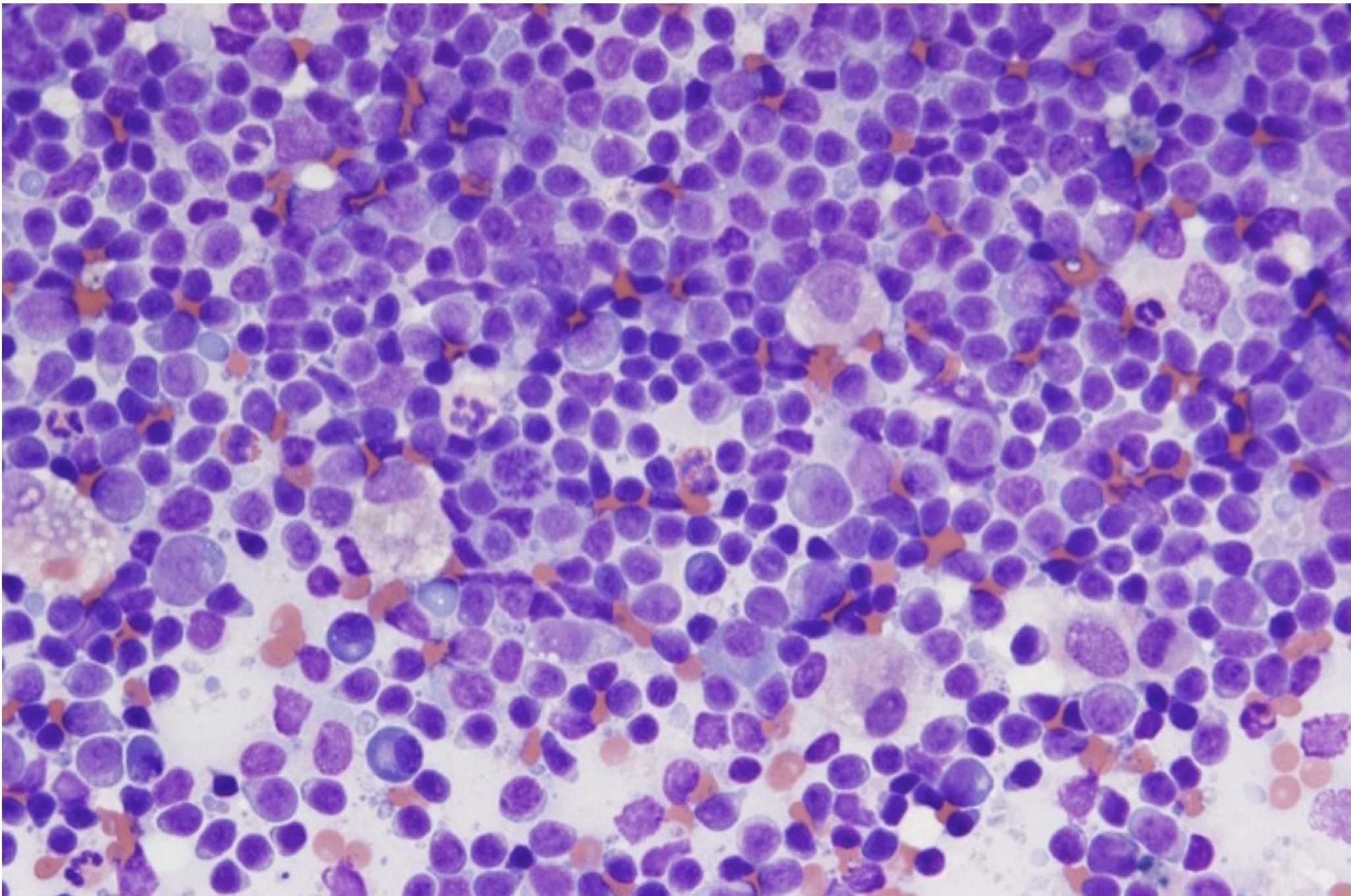 Figure 5.27 Heterogeneous population of lymphocytes from a fine needle sample of a reactive lymph node. Small lymphocytes predominate. There are low numbers of plasma cells. (Wright-Giemsa; IP.) (Image courtesy of Dr. Angelica Galezowski.)