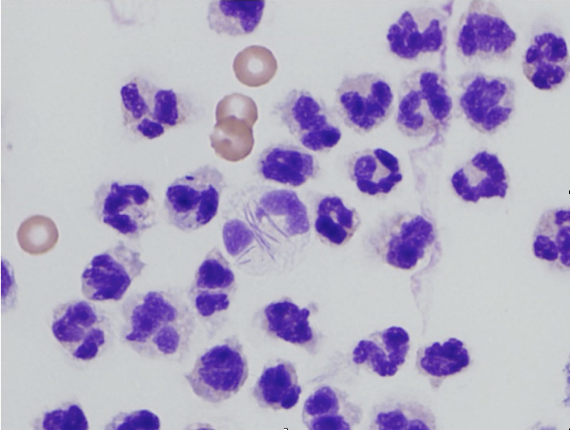 Figure 5.3 Degenerate neutrophils. Neutrophils have pale-staining, swollen nuclei. One cell in the centre contains filamentous rod bacteria. (Wright-Giemsa; HP oil.) (Image courtesy of Dr. Angelica Galezowski.)