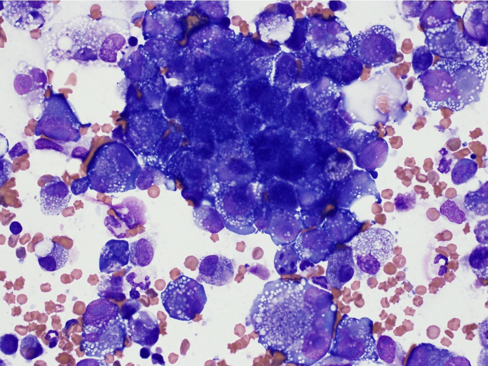 Figure 5.37 Neoplastic effusion. This pleural fluid contains numerous large cells with malignant features. (Wright-Giemsa; HP oil.) (Image courtesy of Dr. Angelica Galezowski.)