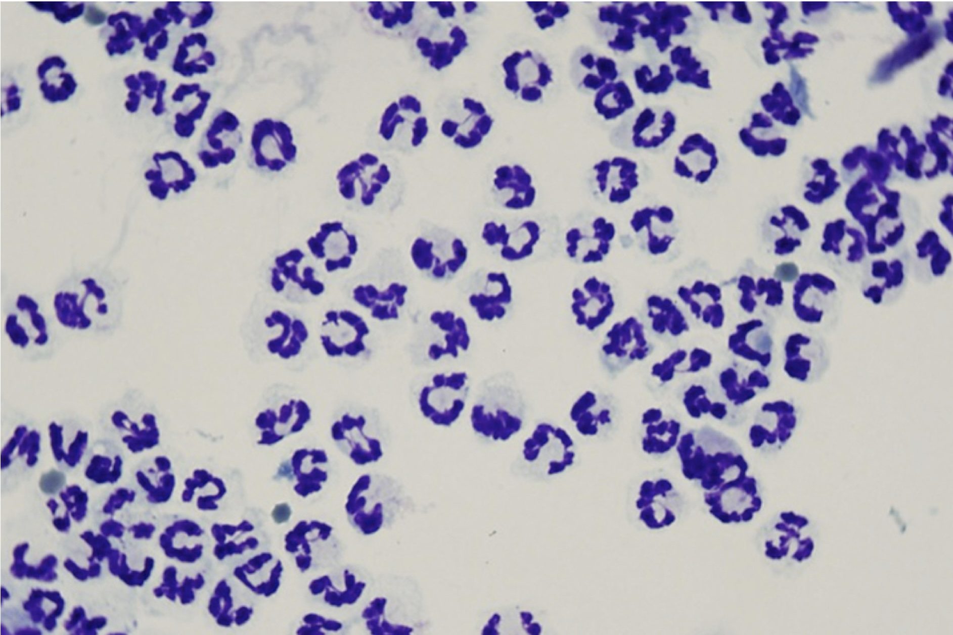 Figure 5.4 Nondegenerate neutrophils. (Wright-Giemsa; IP.) (Image courtesy of Dr. Angelica Galezowski.)