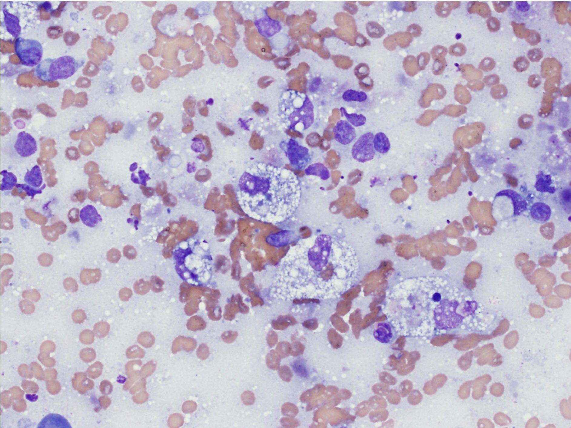 Figure 5.5 Macrophages. Note abundant vacuolated cytoplasm and phagocytosed material. (Wright-Giemsa; HP oil.) (Image courtesy of Dr.Angelica Galezowski.)