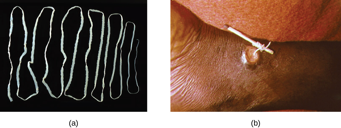 This work is a derivative of "Taenia saginata adult 5260 lores.jpg" and "Dracunculus medinensis.jpg" by Centers for Disease Control and Prevention is licensed under CC0 Photo of tapeworm. Second photo shows removal of tapeworm.