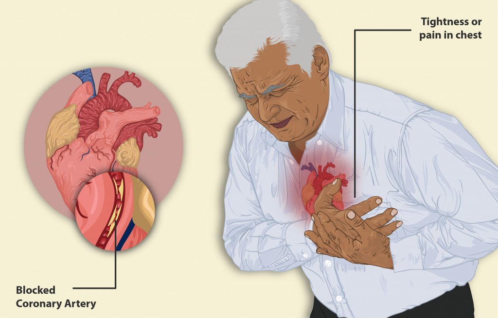 "A man having a Heart Attack.png" by https://www.myupchar.com/en is licensed under CC BY-SA 4.0 illustration of Man having a heart attack
