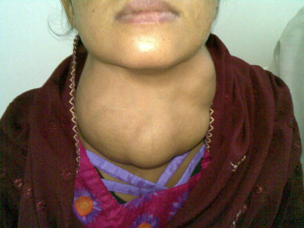 "Goitre.jpg" by Almazi is licensed under CC0 Photo showing a female with a goiter.