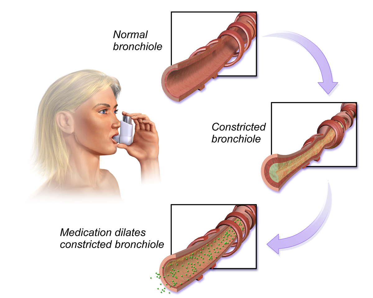 "Bronchodilators" by BruceBlaus is licensed under CC BY 4.0 Access for fee at https://commons.wikimedia.org/wiki/File:Bronchodilators.png Images showing affect of asthma medication on bronchiole, as a woman inhales the medication.