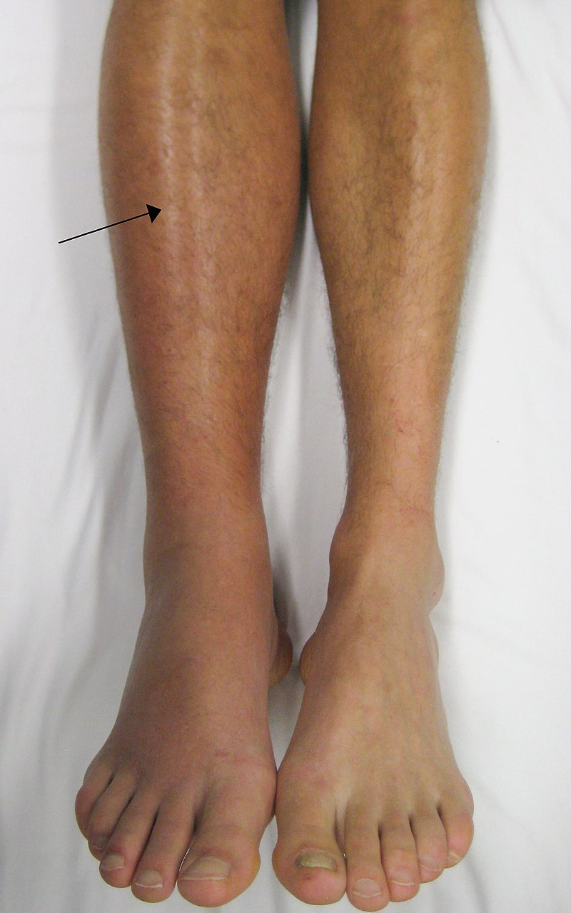 "Deep vein thrombosis of the right leg.jpg" by James Heilman, MD is licensed under CC BY-SA 3.0 Photo showing signs of DVT on the right leg
