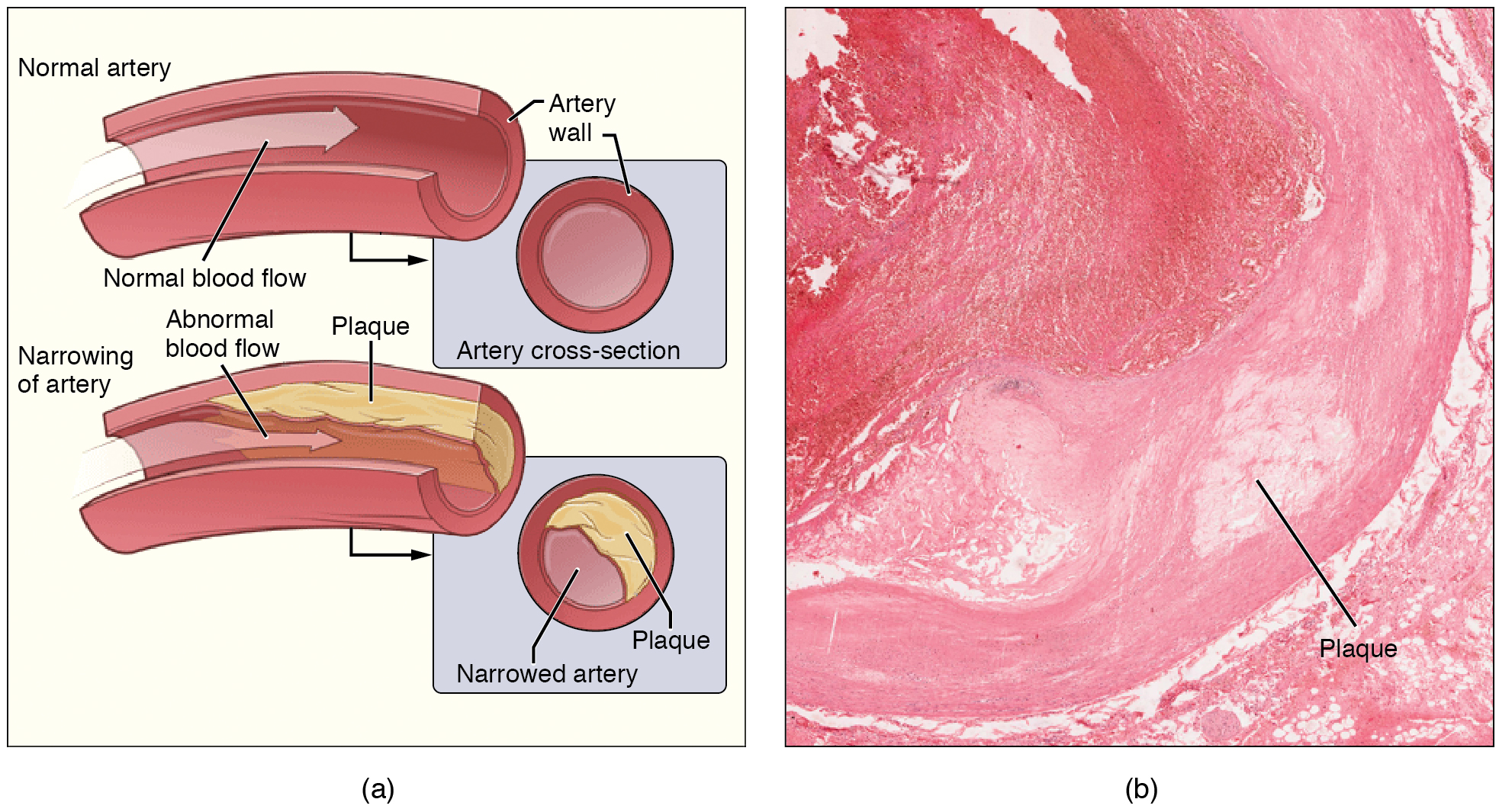 "2113ab Atherosclerosis.jpg" by OpenStax College is licensed under CC BY 4.0 Access for free at https://openstax.org/books/anatomy-and-physiology/pages/20-2-blood-flow-blood-pressure-and-resistance Illustration and micrograph, showing atherosclerosis