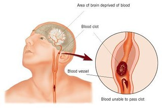 "Stroke Diagram" by ConstructionDealMkting is licensed under CC BY 2.0 Illustration, with labels, showing stroke