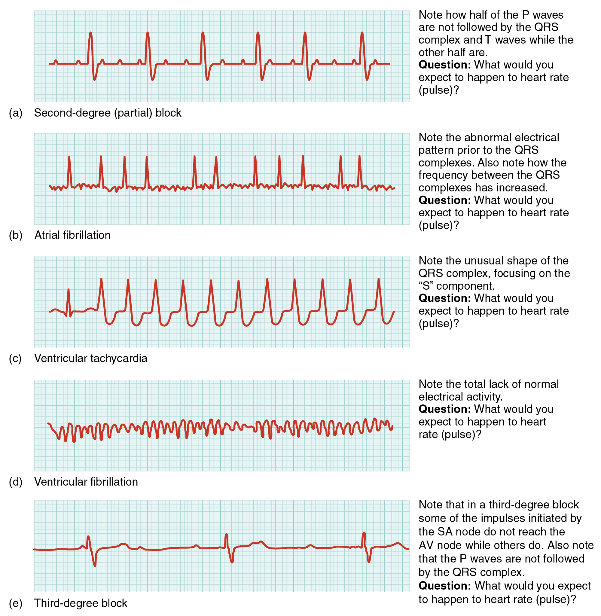 "Common ECG Abnormalities" by CNX OpenStax is licensed under CC BY 4.0 Access for free at https://openstax.org/books/anatomy-and-physiology/pages/19-2-cardiac-muscle-and-electrical-activity Illustrations showing comparisons of common ECG abnormalities