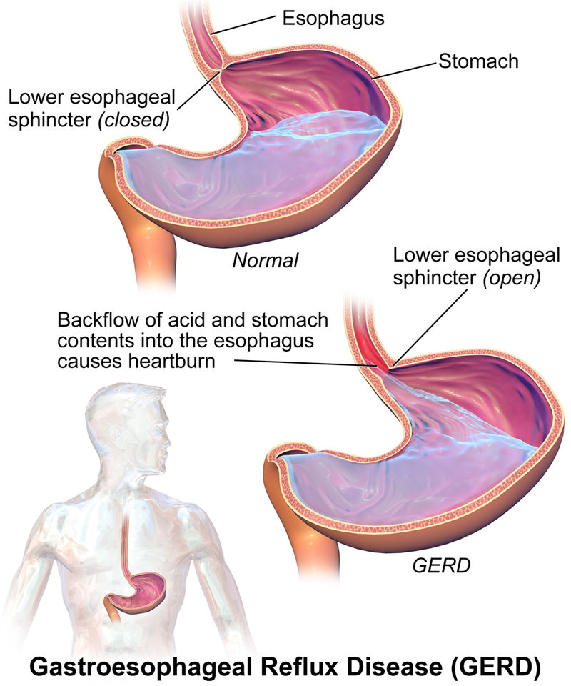 "GERD.png" by BruceBlaus is licensed under CC BY-SA 4.0 Illustration showing gastroesphageal reflux disease