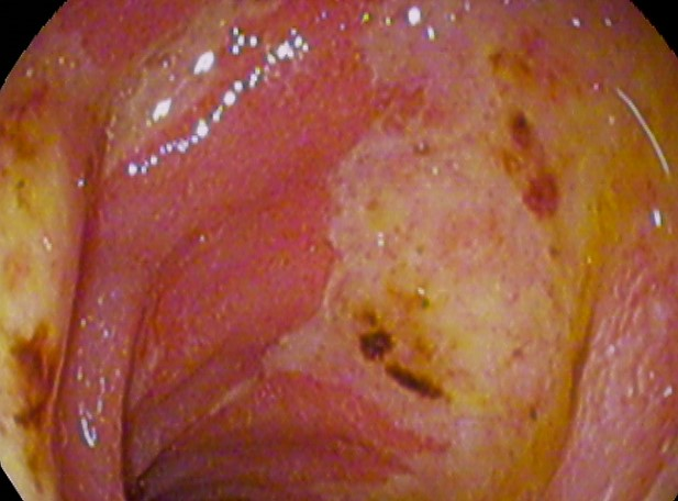 "Duodenal ulcer01.jpg" by melvil is licensed under CC BY-SA 4.0 Photo of peptic ulcer disease