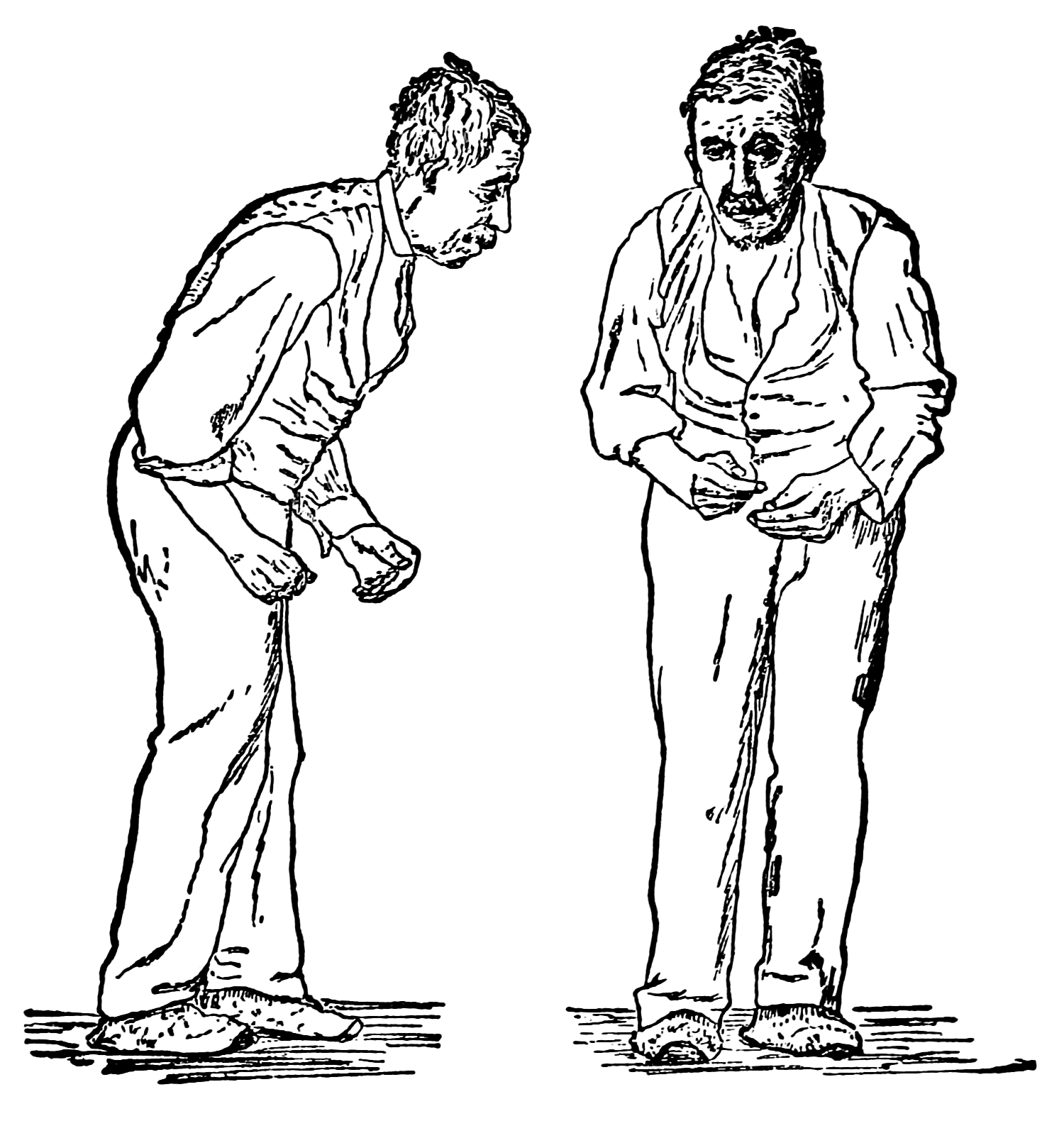 "Paralysis agitans (1907, after St. Leger).png" by William Richard Gowers is licensed under CC0 Illustration of man with stooped posture, shown from front and profile views