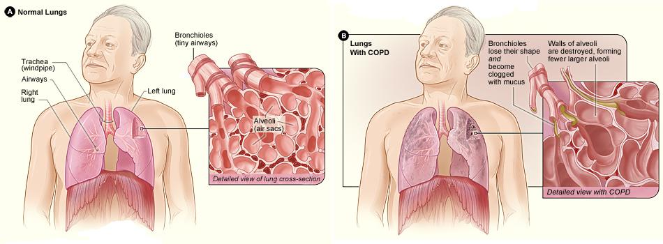"Copd 2010Side.JPG" by unknown is licensed under CC0 Illustrations comparing normal lungs with C O P D lungs.