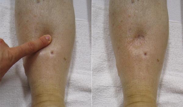 "Combinpedal.jpg" by James Heilman, MD is licensed under CC BY-SA 3.0 Photo showing pitting edema caused by finger applied to shin..