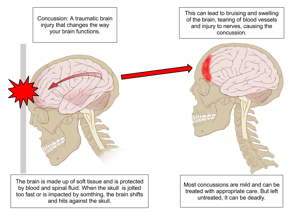 “Concussion Anatomy.png” by Max Andrews is licensed under CC BY-SA 3.0 Illustration showing effects of concussion with labels