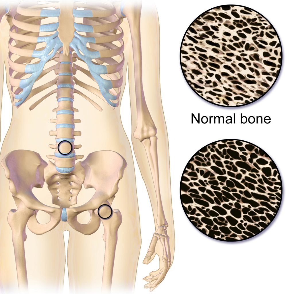 “Osteoporosis Effect and Locations.jpg” by BruceBlaus is licensed under CC BY-SA 4.0 Illustration with closeups, showing osteoporosis versus normal bone density