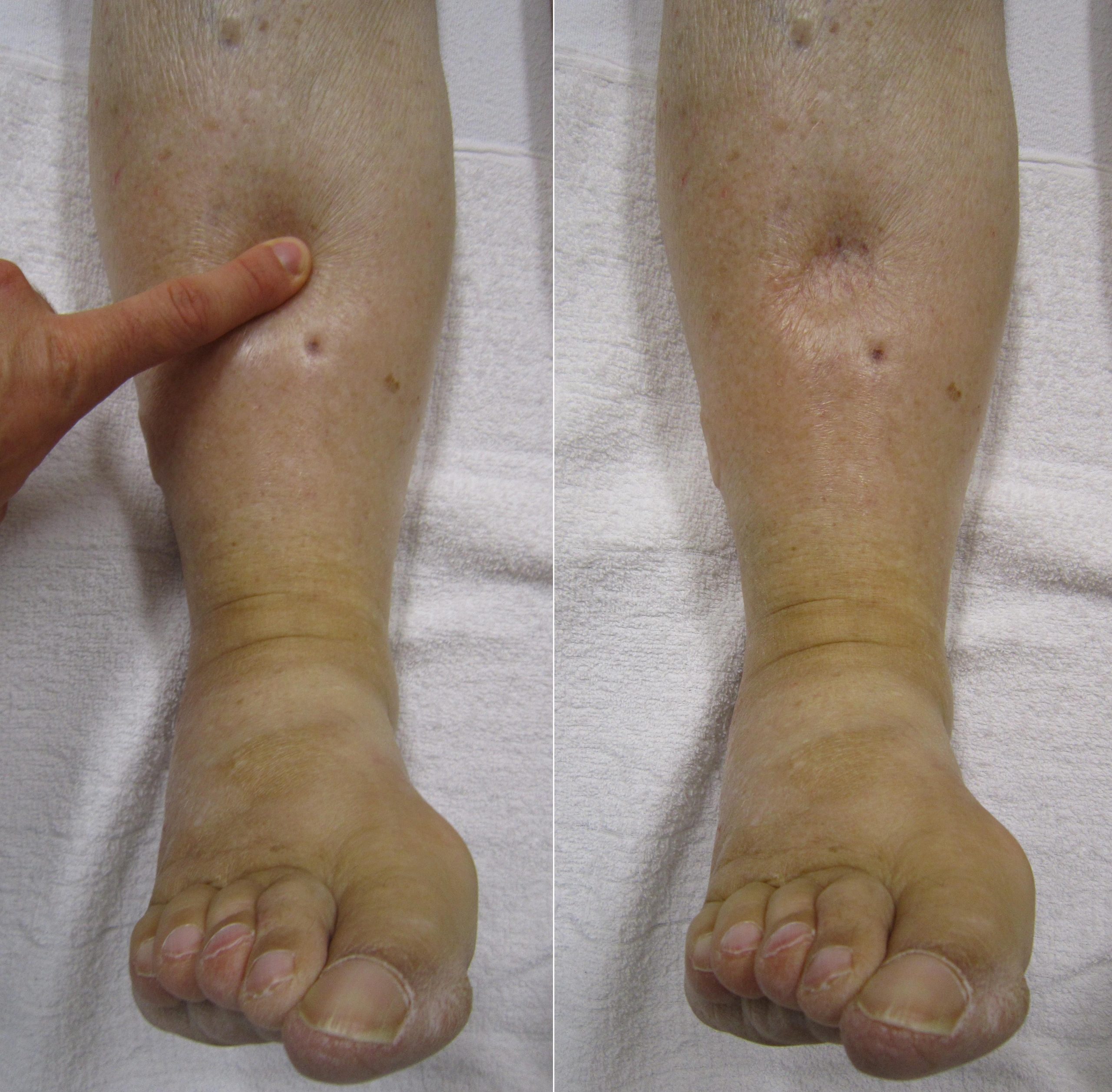 “Combinpedal.jpg” by James Heilman, MD is licensed under CC BY-SA 3.0 Photo showing a finger pressing into a patient's leg to assess for edema