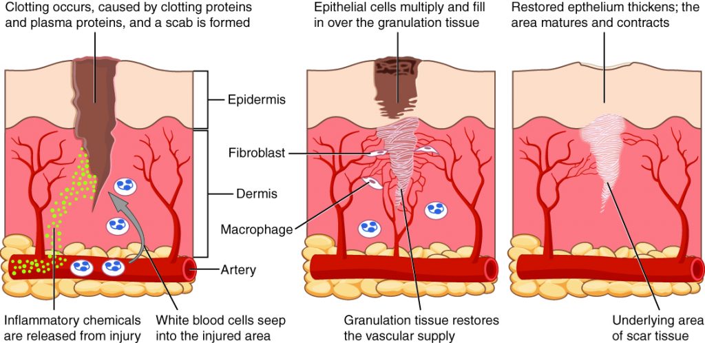 “417 Tissue Repair.jpg” by OpenStax College and is licensed under CC BY 3.0. Access for free at https://openstax.org/books/anatomy-and-physiology/pages/1-introduction Illustration showing phases of wound healing, with labels