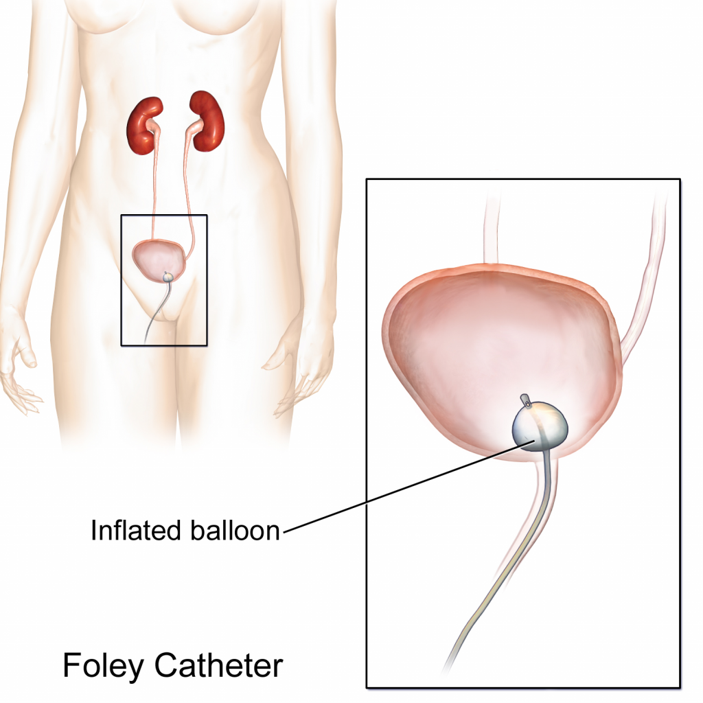 ”Foley Catheter.png” by BruceBlaus is licensed under CC BY-SA 4.0 Illustration showing placement of Foley catheter in bladder