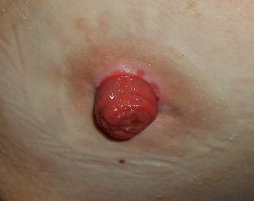 ”Ileostomy 2017-02-20 5351.jpg” by Salicyna is licensed under CC BY-SA 4.0 Photo showing closeup of a ileostomy stoma