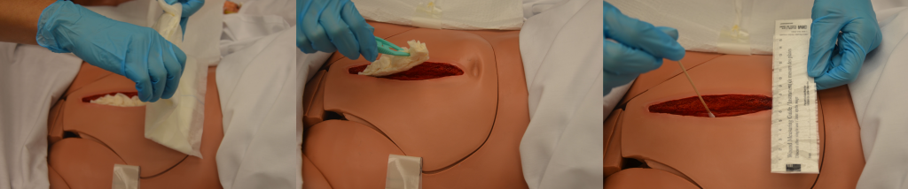 “DSC_1742.jpg” by British Columbia Institute of Technology (BCIT) is licensed under CC BY 4.0. Access for free at https://ecampusontario.pressbooks.pub/clinicalskills/chapter/4-5-complex-dressing-change/ Photo showing the process of removing dressings and wound assessment of a simulated wound