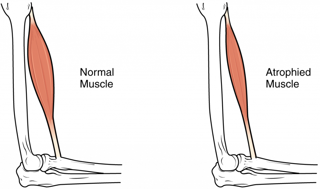 “1025 Atrophy.png” by OpenStax is licensed under CC BY 4.0. Access for free at https://openstax.org/books/anatomy-and-physiology/pages/10-6-exercise-and-muscle-performance. Illustration showing a normal and an atrophied muscle