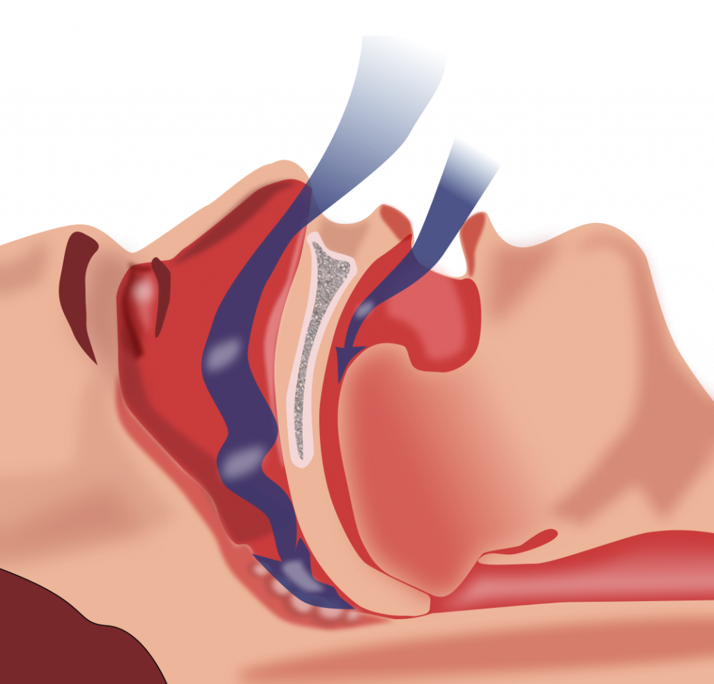 “Obstruction ventilation apnée sommeil.svg” by Habib M’henni is in the Public Domain Illustration showing tissue placement in obstructive sleep apnea