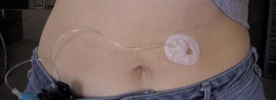 “insulin pump day 1“ by Erin Stevenson O’Connor is licensed under CC BY-SA 2.0 Photo of in insulin pump placed on an abdomen