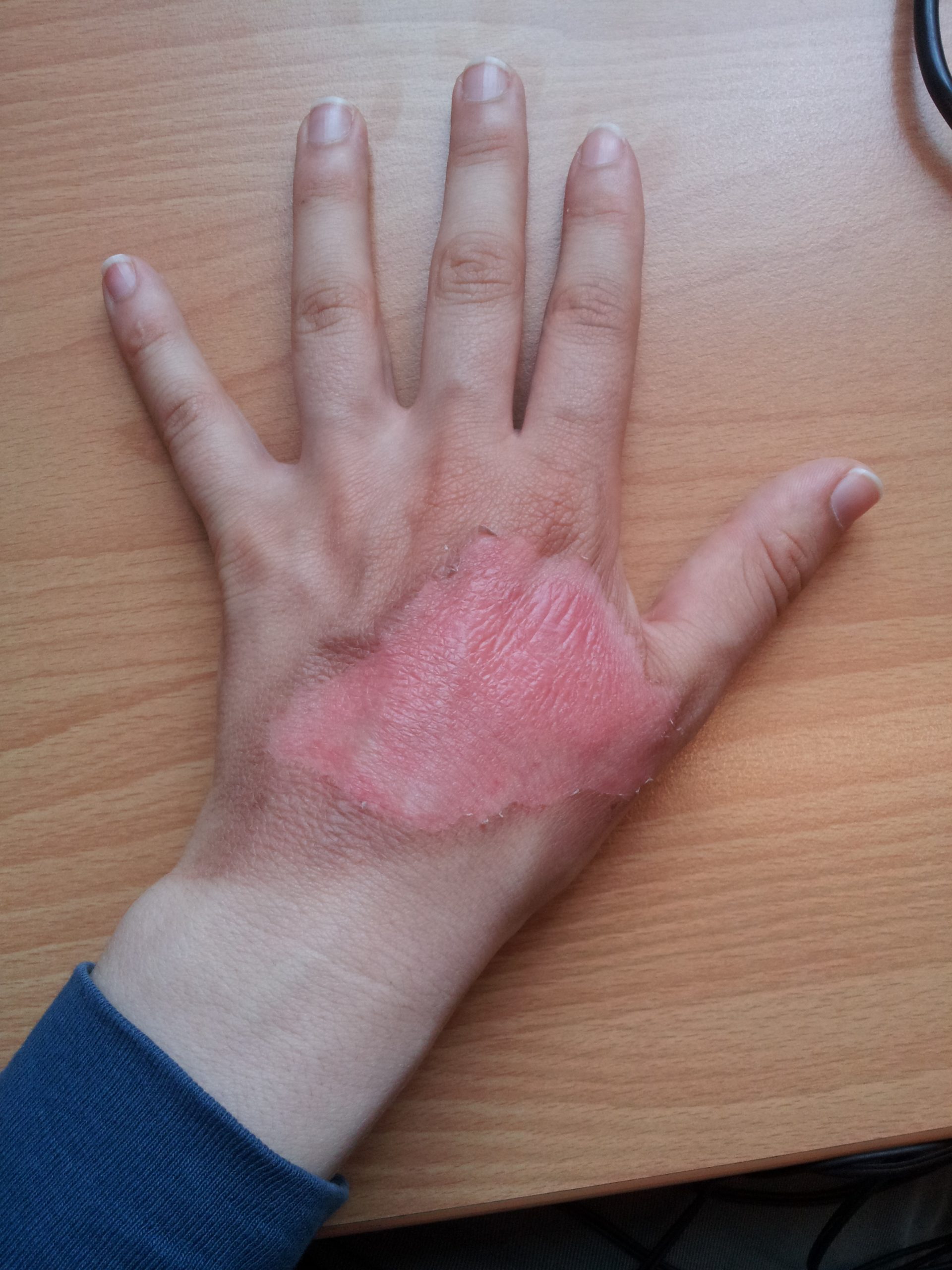 “1Veertje hand-burn-do8.jpg” by 1Veertje is licensed under CC BY-SA 3.0 Photo showing hand with healing second degree burn