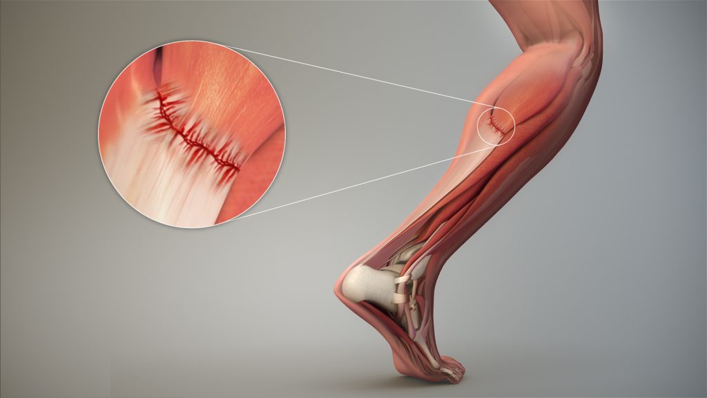 “3D Medical Animation Depicting Strain-Tendon.jpg” by https://www.scientificanimations.com is licensed under CC BY-SA 4.0 Image showing closeup of a strained tendon in the calf muscle