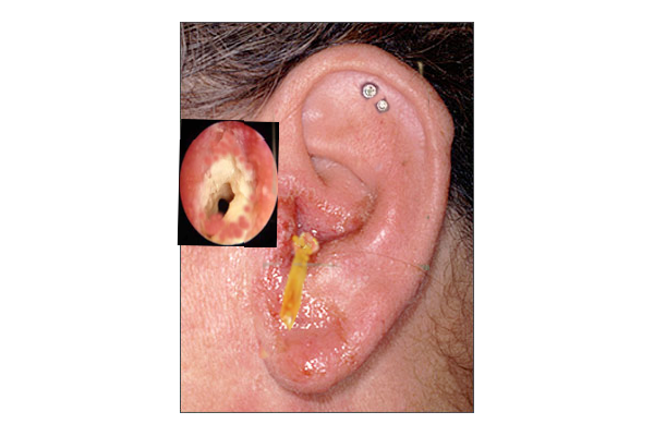“otitis externa.gif” by S bhjimji MD is licensed under CC BY 4.0. Access for free at https://www.ncbi.nlm.nih.gov/books/NBK556055/ Photo showing ear infected with otitis externa, or swimmer's ear