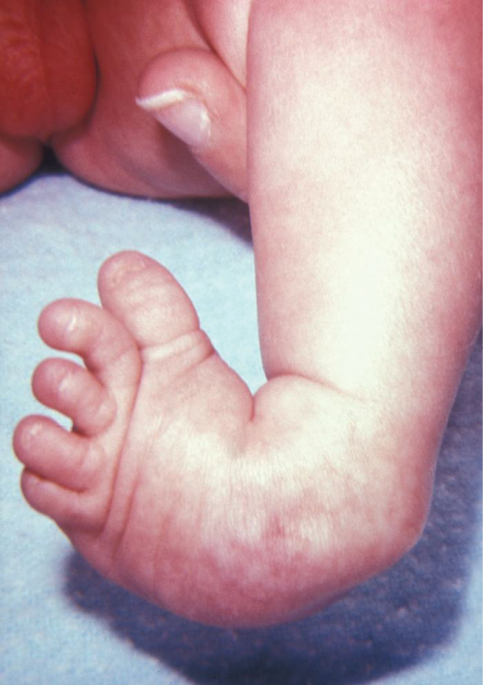 “813 Clubfoot.jpg” by OpenStax College is licensed under CC BY 3.0 Photo showing closeup of clubfoot in an infant