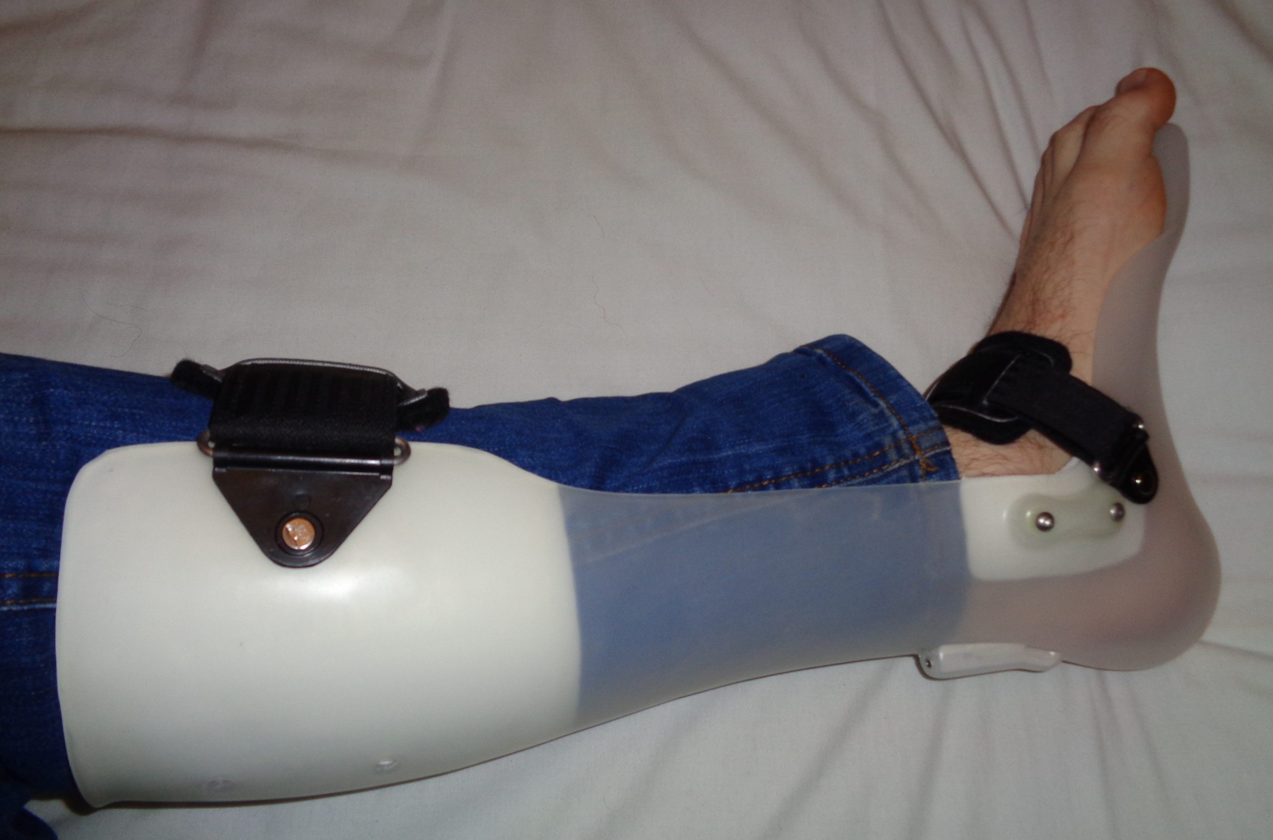 “AFO brace for foot drop.JPG” by Pagemaker787 is licensed under CC BY-SA 4.0 Photo showing brace being worn for foot drop