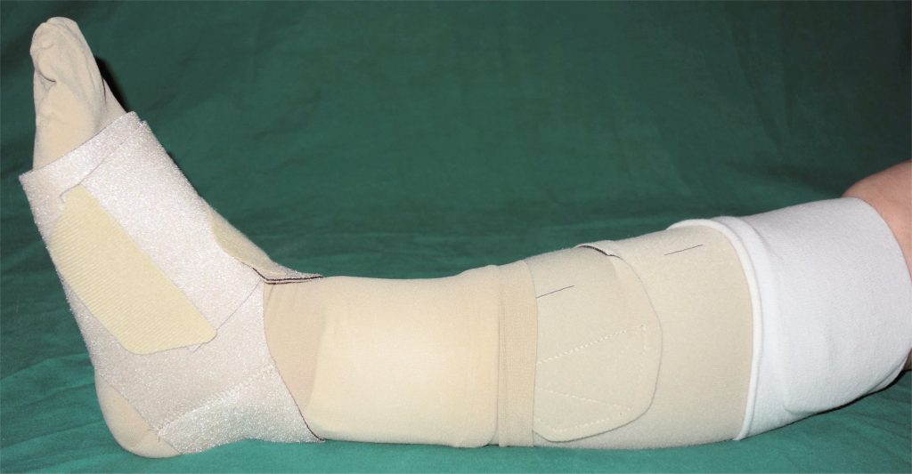 "Adaptive_Kompressionsbandage_mit_Fußteil.jpg" by Enter is in the Public Domain Photo showing leg wrapped in Compression Dressing for Lymphedema