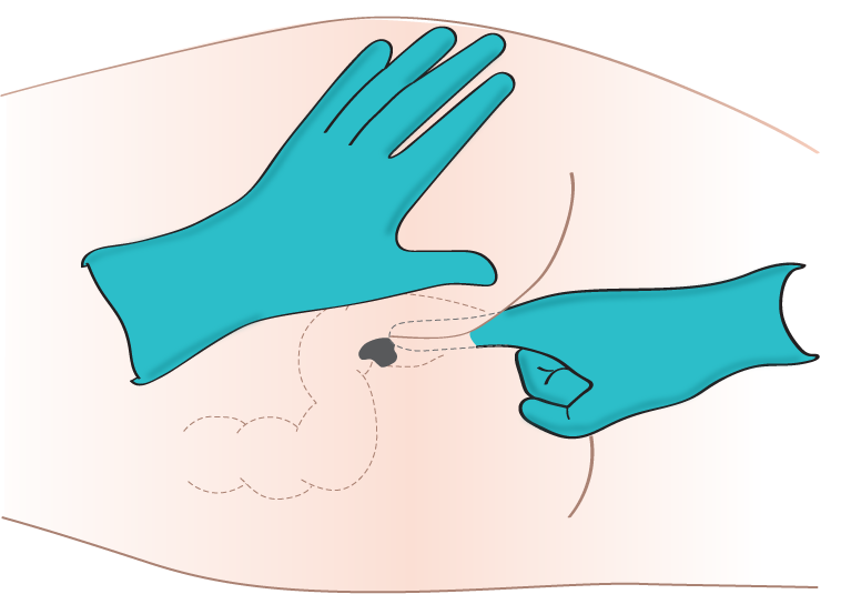 "Administering-med-rectally-2.png" by British Columbia Institute of Technology (BCIT) is licensed under CC BY 4.0. Illustration showing administration of a rectal suppository