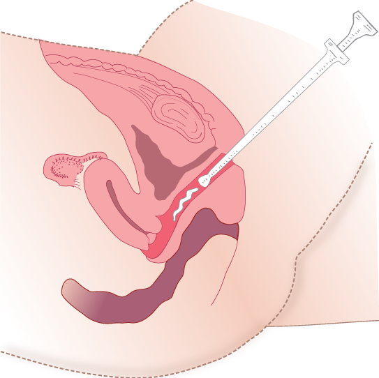 “Administering-med-vaginally-appliator.png” by by British Columbia Institute of Technology (BCIT) is licensed under CC BY 4.0. Access for free at https://opentextbc.ca/clinicalskills/chapter/6-4-rectal-and-vaginal-medications /. Illustration showing administration of vaginal medication