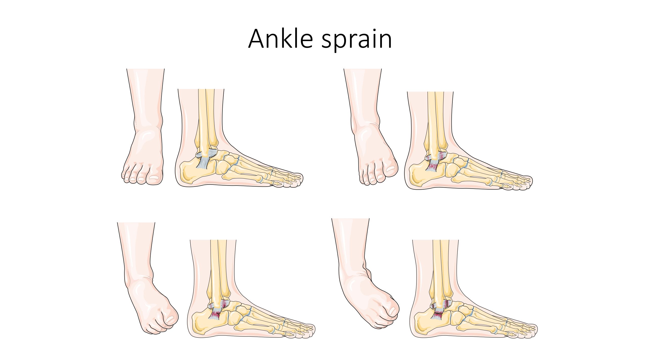 “Ankle sprain -- Smart-Servier.jpg” by Laboratoires Servier is licensed under CC BY-SA 3.0 Illustration showing ligaments affected by an ankle sprain