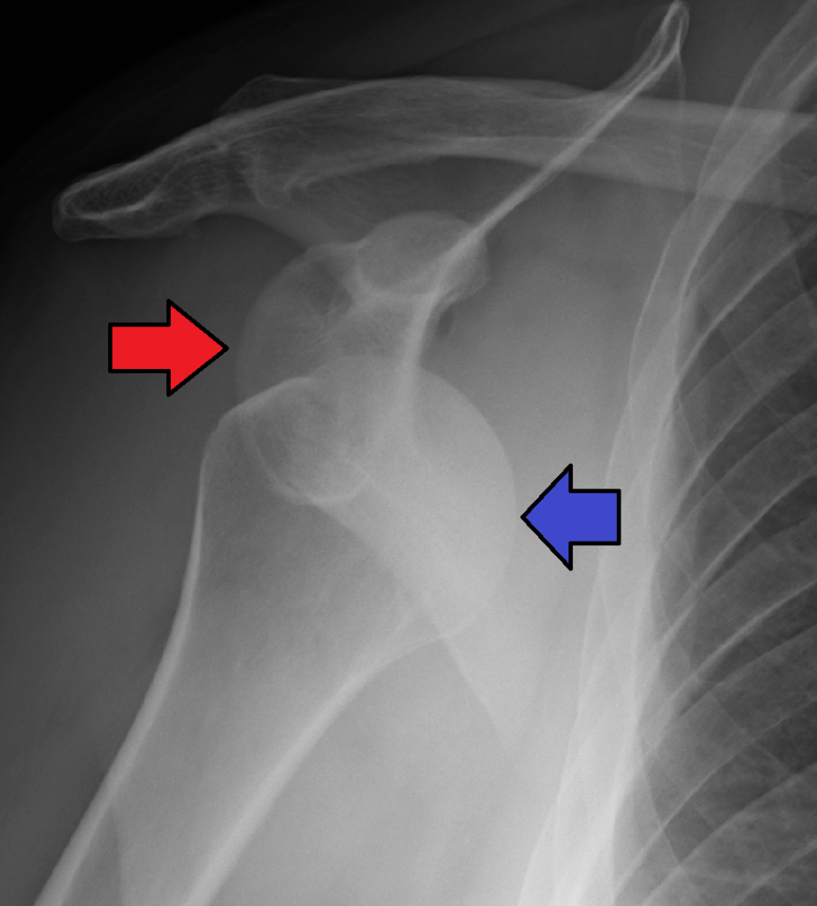 “AnterDisAPMark.png” by James Heilman, MD is licensed under CC BY-SA 4.0 X-ray image, with arrows, showing dislocated shoulder