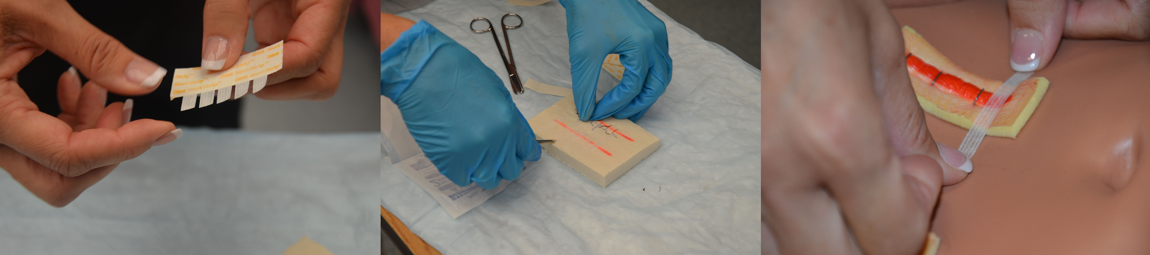 “DSC_1658.jpg” and “DSC_09811.jpg” by British Columbia Institute of Technology (BCIT) are licensed under CC BY 4.0. Access for free at https://opentextbc.ca/clinicalskills/chapter/4-3-suture-care-and-removal/. “DSC_0234.jpg” by British Columbia Institute of Technology (BCIT) are licensed under CC BY 4.0. Access for free at https://opentextbc.ca/clinicalskills/chapter/4-4-suture-care-and-removal/. Photo showing three views of applying steristrips to a simulated wound