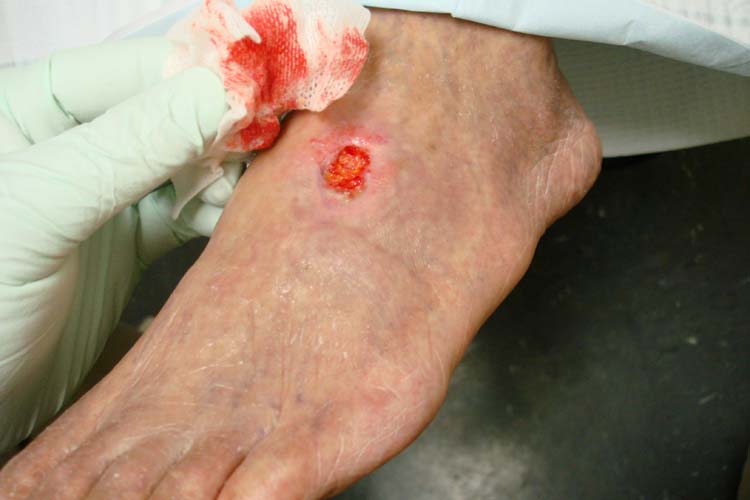 “Arterial ulcer peripheral vascular disease.jpg” by Jonathan Moore is licensed under CC BY 3.0 Photo showing arterial ulcer on top of a foot