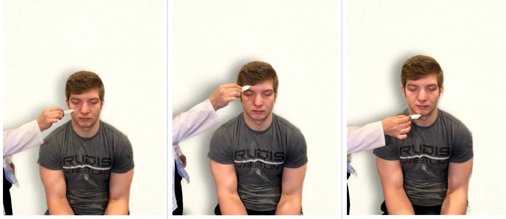 "Neuro Exam Image 28", "Cranial Exam Image 14", and Neuro Exam Image 36" by Meredith Pomietlo for Chippewa Valley Technical College is licensed under CC BY 4.0 Photos of simulated patient being assessed for trigeminal sensory function