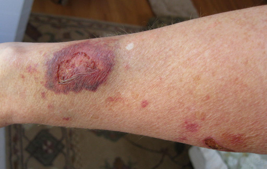 “Atrophied skin.png” by sansea2 is licensed under CC BY-SA 3.0 Photo showing a wound on the forearm healing by secondary intention