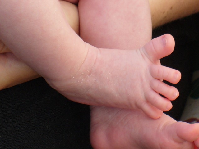 “Babinski-newborn.jpg” by Medicus of Borg is licensed under CC BY-SA 3.0 Photo showing closeup of an infant's splayed toes